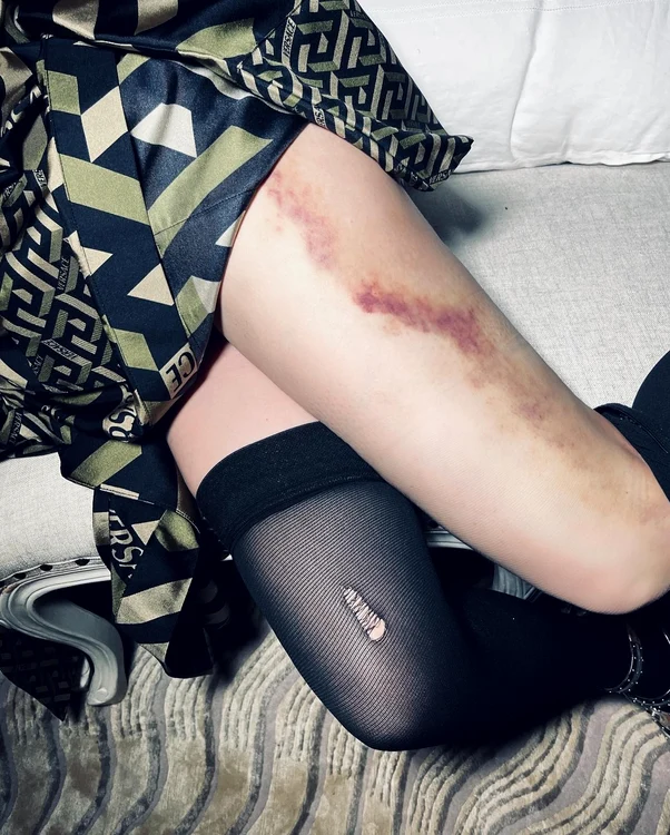 Auci! Așa arată vânătaia de pe piciorul cântăreței de 63 de ani - foto Instagram