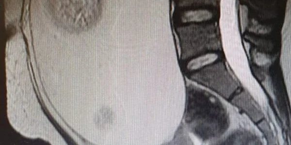 tumora gigant Mioveni