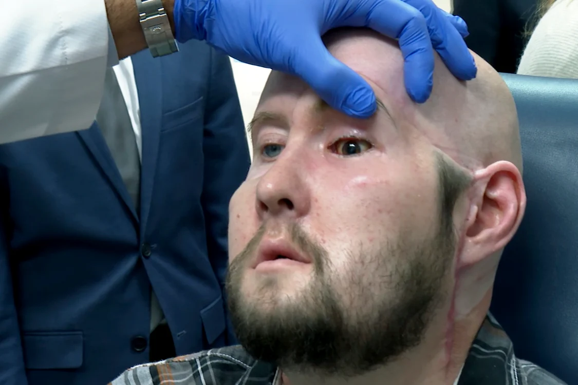 aaron james transplant de ochi profimedia jpg