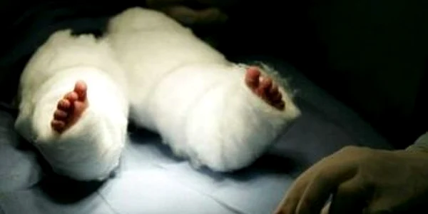 La numai 10 ani, fetiţa născută cu "sindromul sirenei" a murit