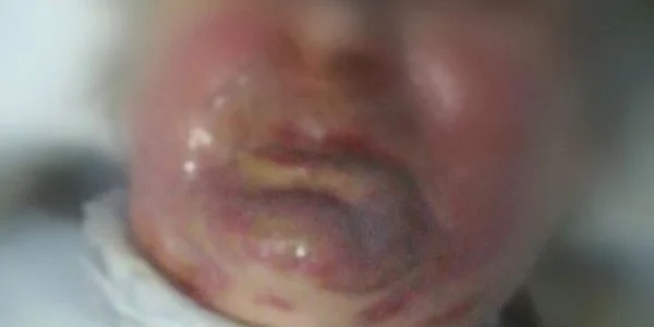 Femeia care a suferit arsuri în urma accidentului de la Spitalul Sfânta Maria