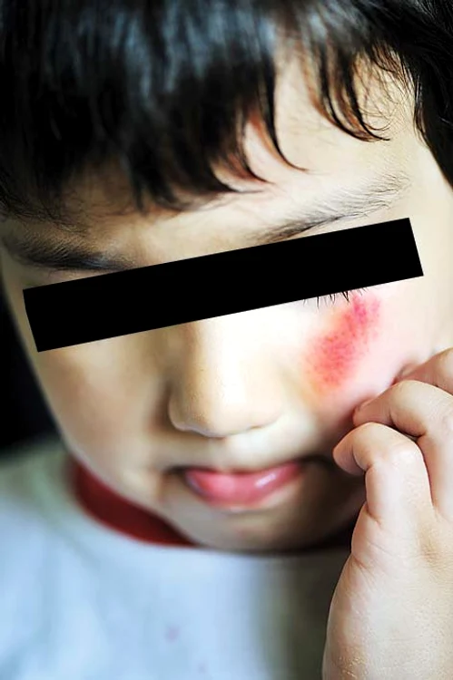 
    Băieţelul a ajuns la spital cu  mai multe răni şi fracturi  