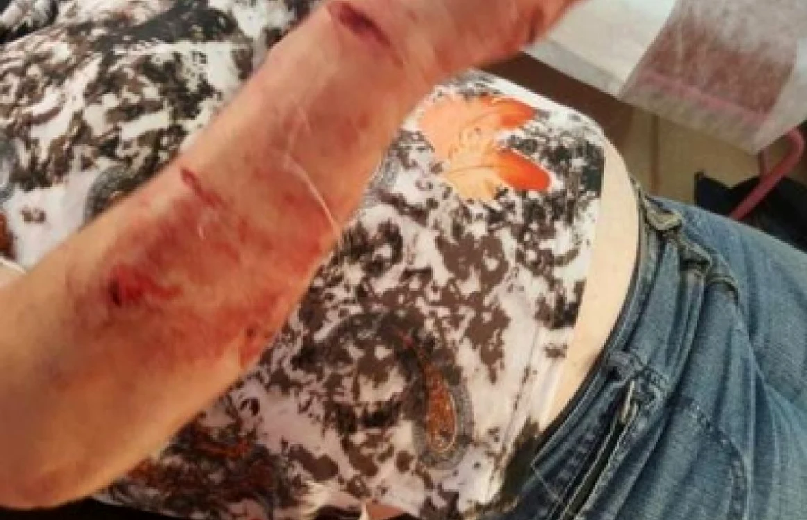Femeia a fost atacată de câinele pe care-l hrănea de 10 ani FOTO: mesagerul.ro