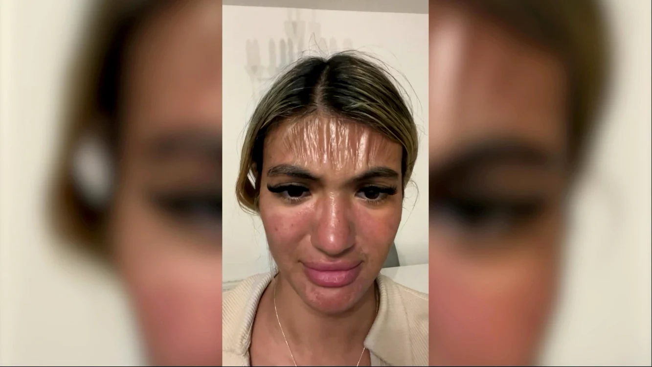 Pielea de pe fruntea tinerei s-a umflat din cauza arsurilor solare. Sursa: Profimedia