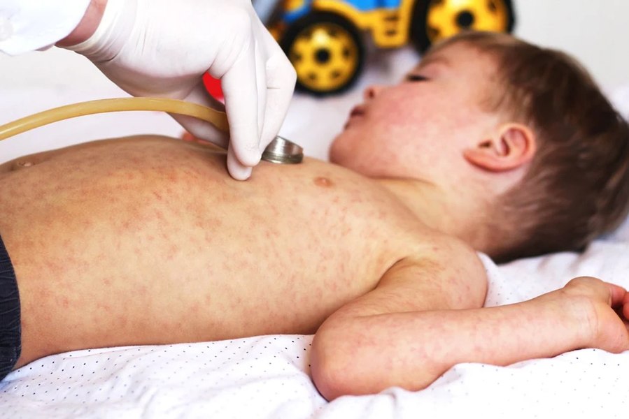 Primul caz de rujeolă, după ani de inexistenţă, în Neamţ. Scade constant rata de vaccinare a copiilor 