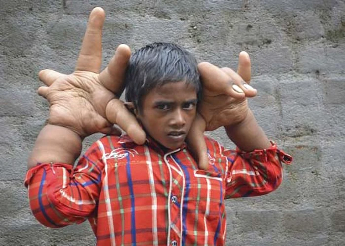 Kaleem are doar 8 anișori, însă afecțiunea de care suferă face ca mâinile să îi fie gigantice