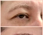 blefaroplastie iancu morad luxury aesthetics 1 jpg