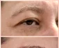 blefaroplastie iancu morad luxury aesthetics 1 jpg