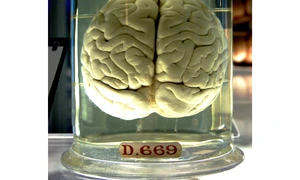 Stimulare magnetică transcraniană jpeg