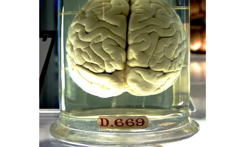 Stimulare magnetică transcraniană jpeg