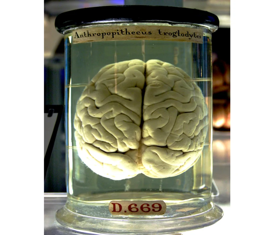 Stimulare magnetică transcraniană jpeg