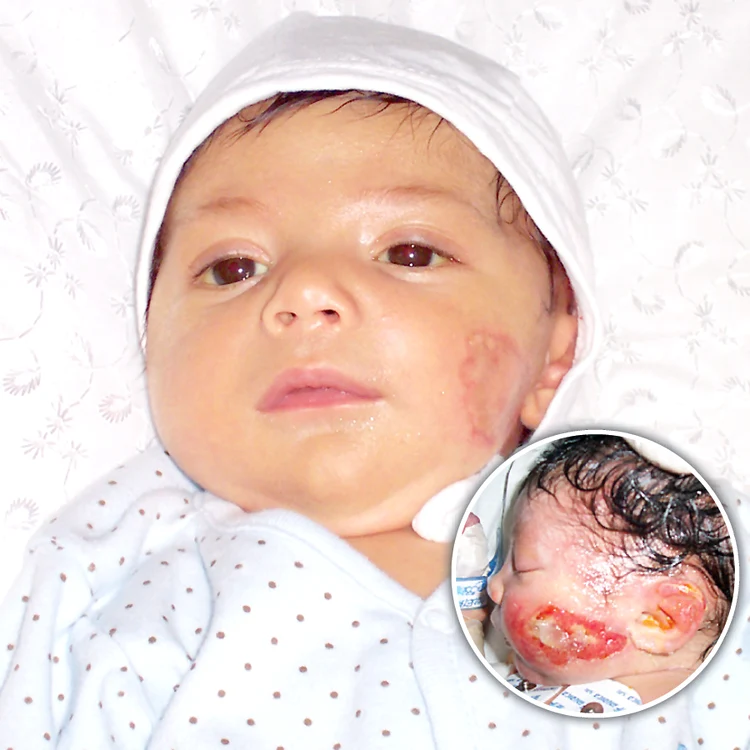 
    Aşa arăta micuţul înainte de transplantul  de piele(bulă). Acum, Alex  e bine şi are 4,5 kg  