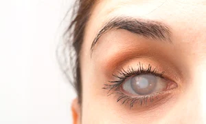 cataracta jpg