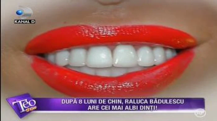 Raluca Bădulescu a investit mult timp și mulți bani pentru noul ei zâmbet