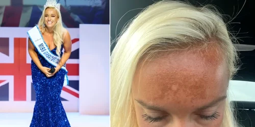 Fosta Miss Marea Britanie Jen Atkins și afecțiunea cauzată de bronzantul nazal Colaj YouTube This Morning jpg