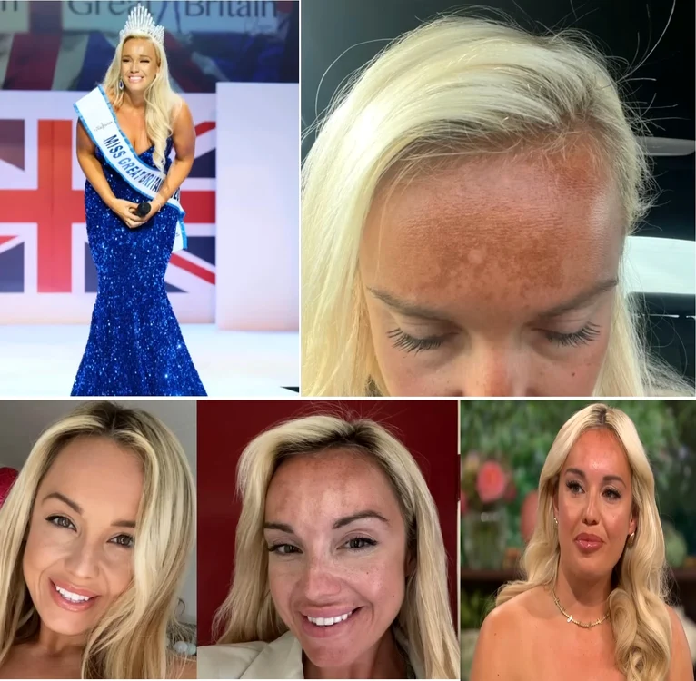 Fostul model Jen Atkins și afecțiunea cauzată de bronzantul nazal Colaj YouTube This Morning
