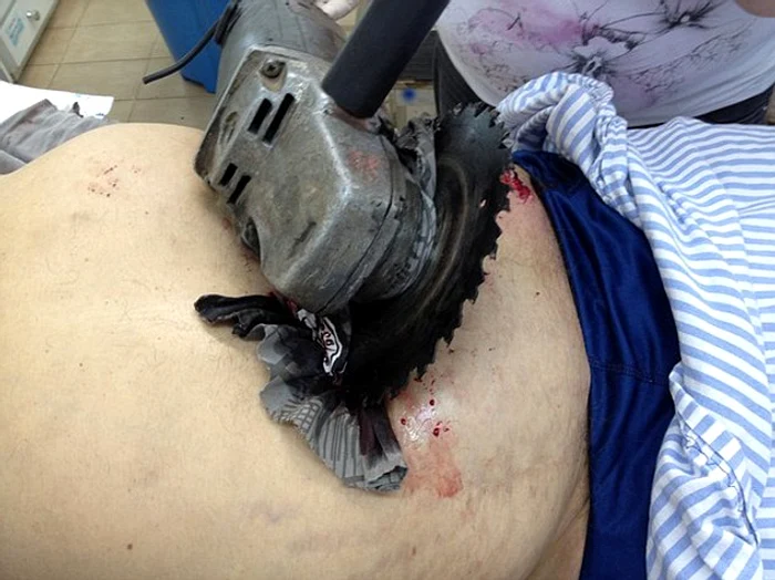 Fierăstrăul i-a intrat în stomac