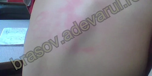Profesorul i-a lăsat o urmă vizibilă pe spate Foto: fam. Drăguşin