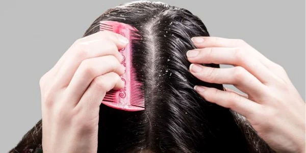 Scapă de mătreaţă rapid cu 10 remedii naturiste ieftine