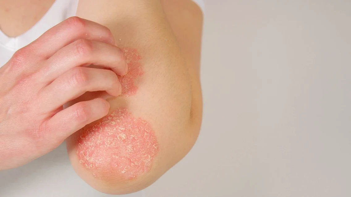 psoriazis jpg