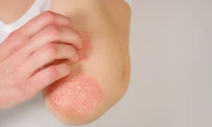 psoriazis jpg