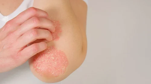 psoriazis jpg