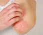 psoriazis jpg