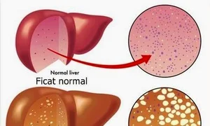 alimente pentru ficat gras  ce mananci daca ai aceasta afectiune jpeg