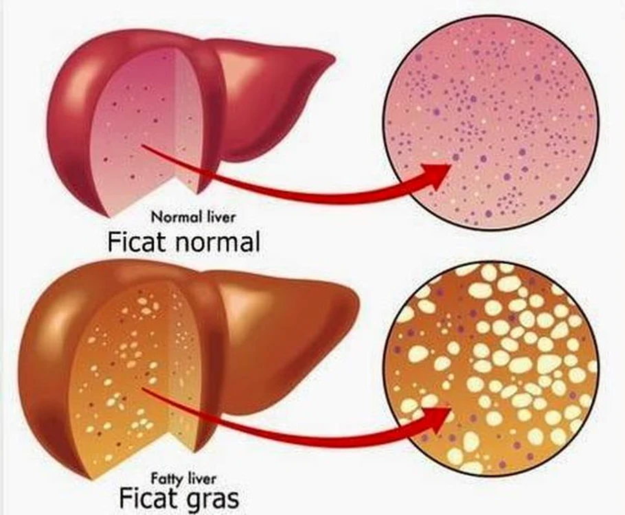 
    Alimente pentru ficat gras. Ce mănânci dacă ai această afecţiune  