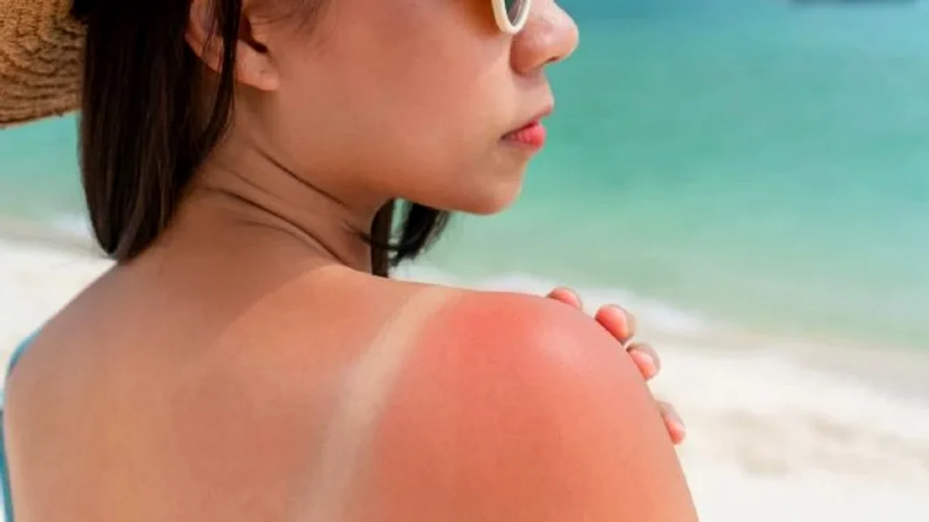 Aloe Vera vindecă arsurile provocate de soare