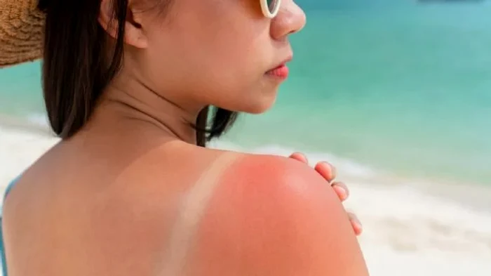 Aloe Vera vindecă arsurile provocate de soare