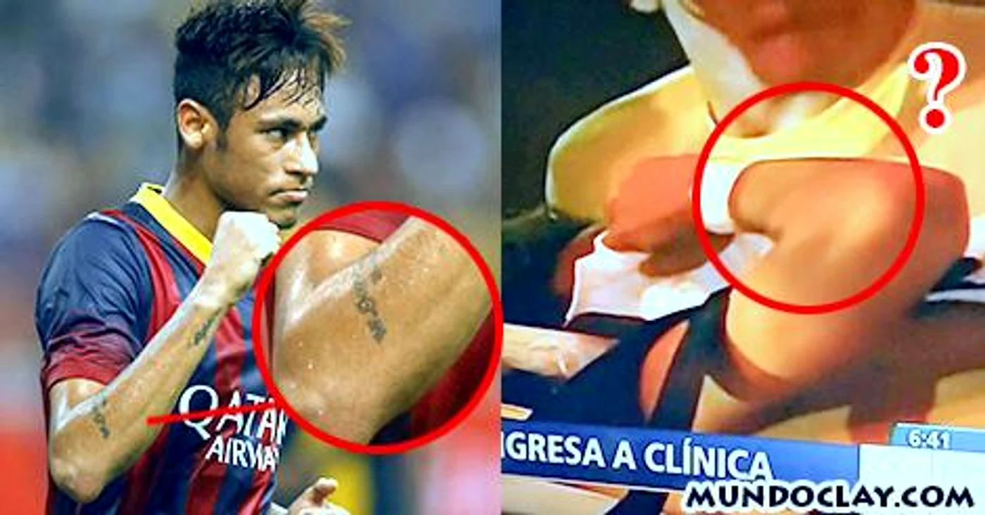 
    În imagine se observă că cel de pe targă nu are pe mâna dreaptă tatuajul lui Neymar  