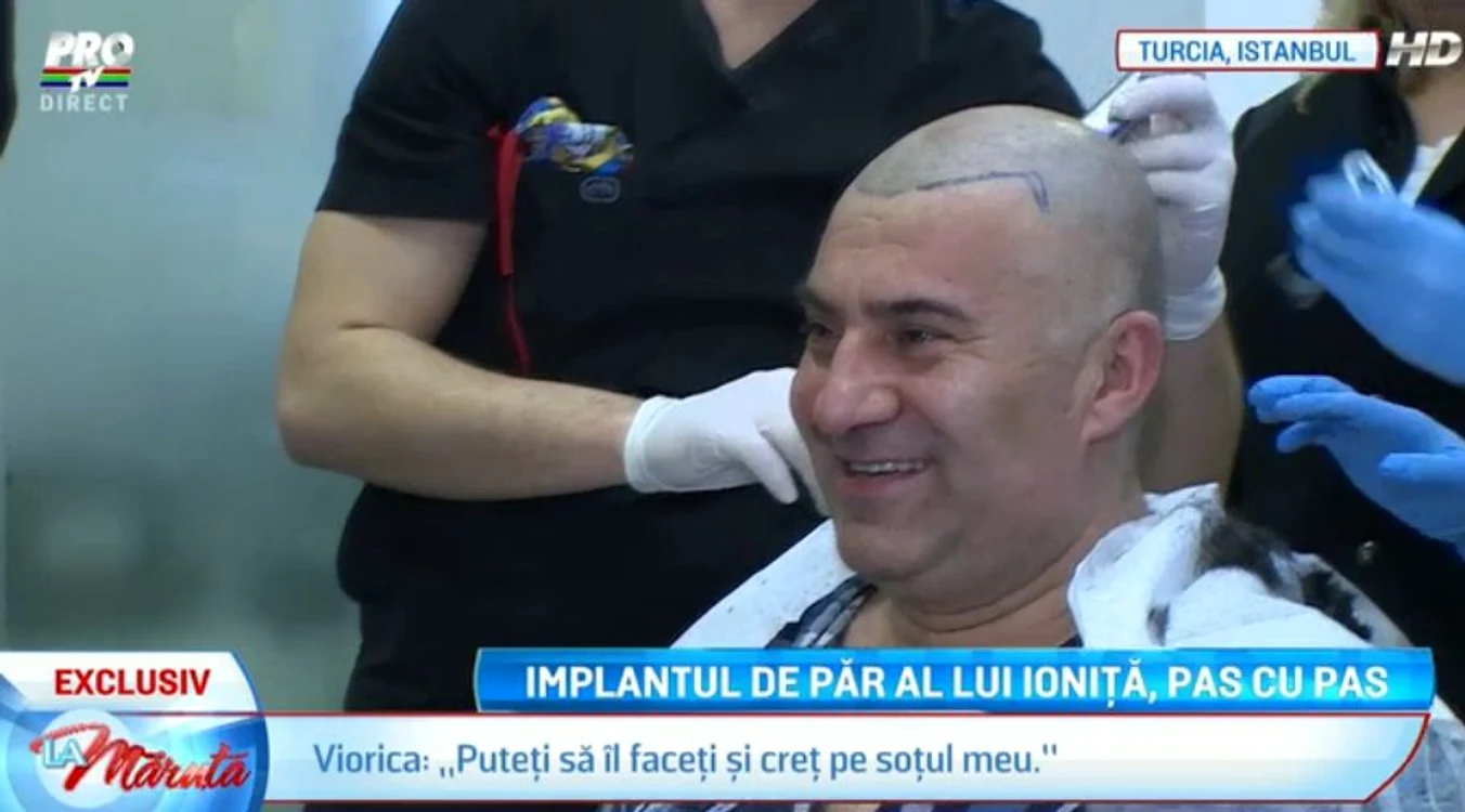 Artistului îi vor fi transplantate 6.600 de fire de păr