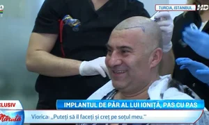 Artistului îi vor fi transplantate 6 600 de fire de păr jpeg