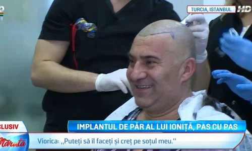 Artistului îi vor fi transplantate 6 600 de fire de păr jpeg