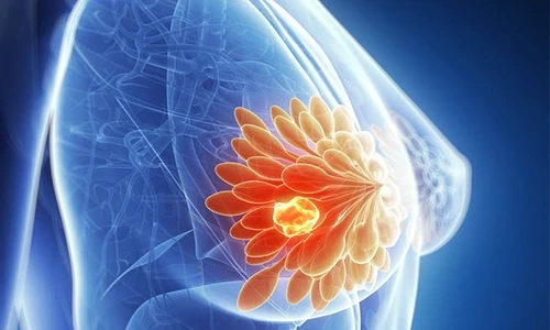 1 cancer mamar simptome jpg jpeg