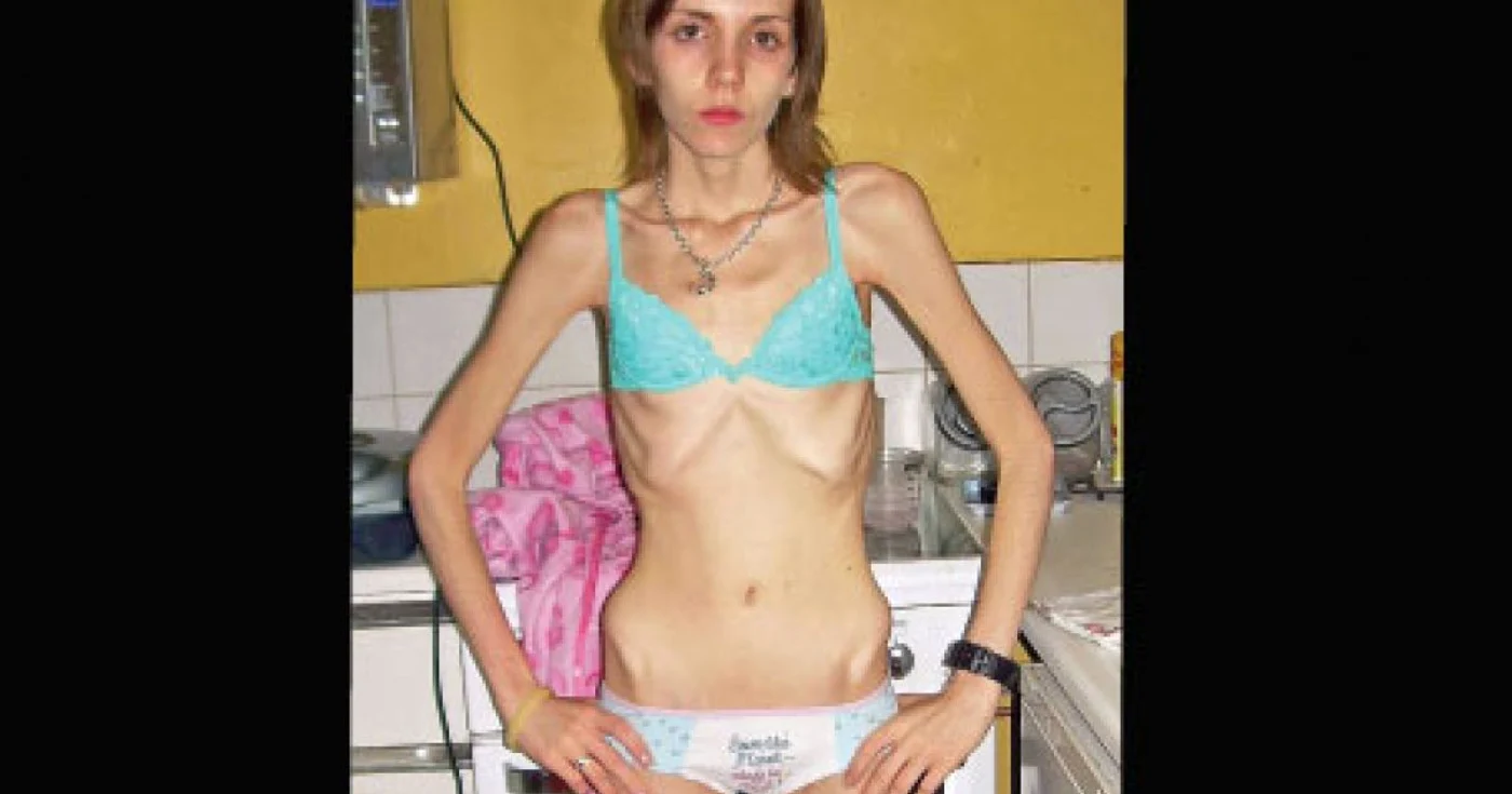 Ruth a fost la un pas de a-şi pierde viaţa din cauza anorexiei