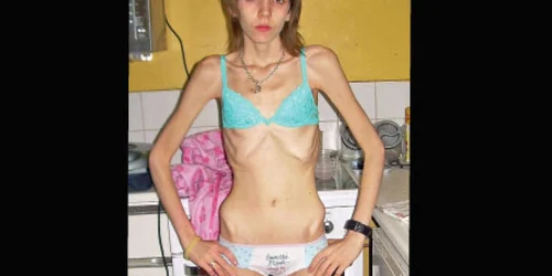 Ruth a fost la un pas de a-şi pierde viaţa din cauza anorexiei