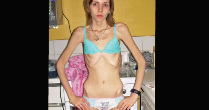Ruth a fost la un pas de a-şi pierde viaţa din cauza anorexiei