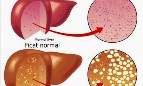 1 alimente pentru ficat gras ce mananci daca ai aceasta afectiune 2 jpg jpeg