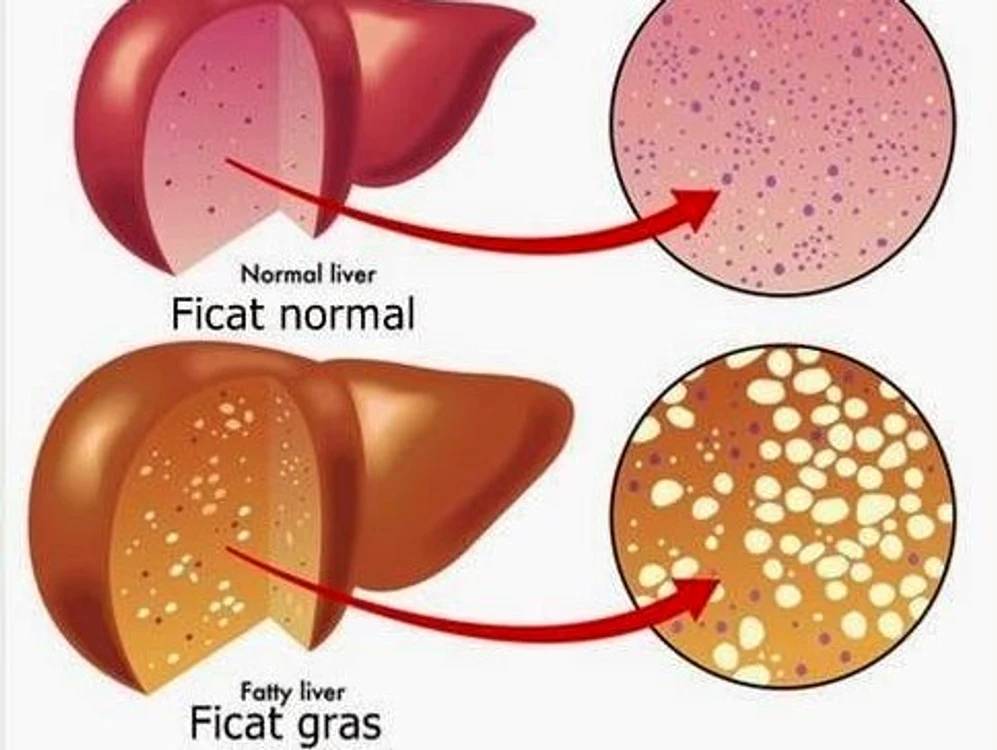 1 alimente pentru ficat gras ce mananci daca ai aceasta afectiune 2 jpg jpeg