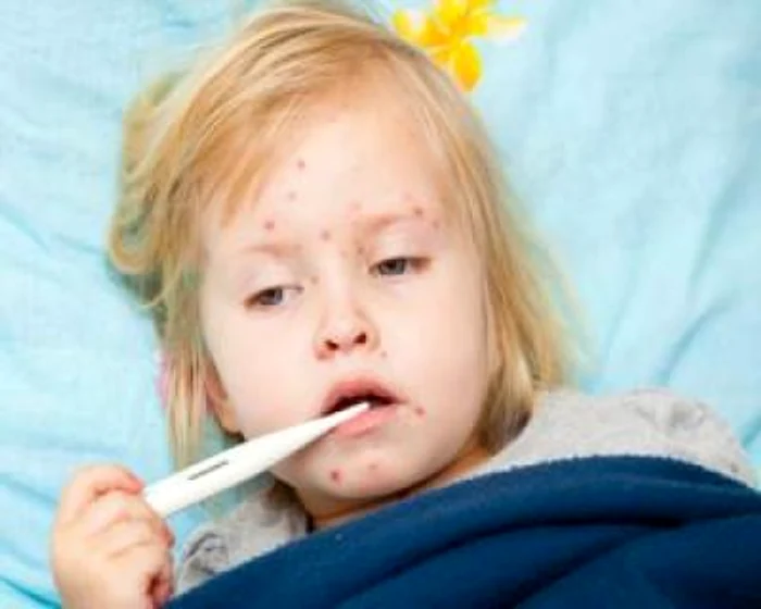 
    Cazurile de rujeolă au atins un nivel îngrijorător şi în Belgiafoto: arhiva personală  