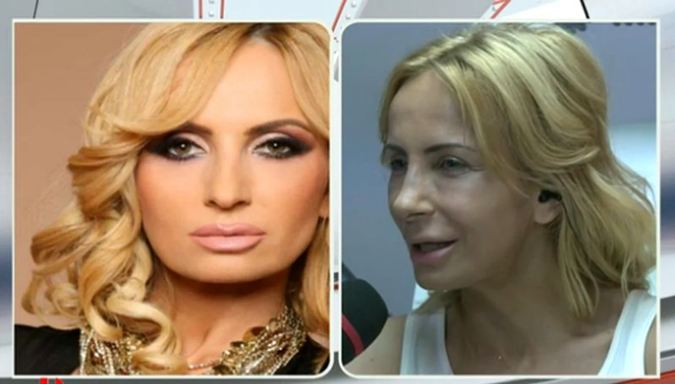 Daniela Gyorfi este încântat de felul în care arată nasul ei după operaţie. (captură Pro TV)