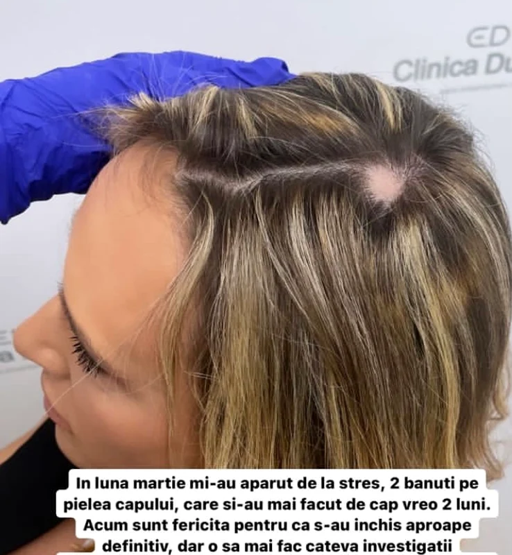 Carmen Negoiță are porțiuni de chelie Sursa Instagram