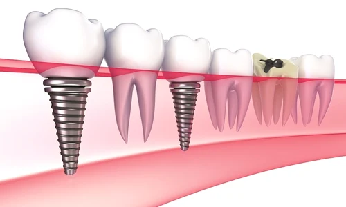 1 implant dentar jpg jpeg