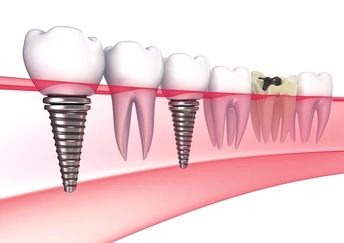 1 implant dentar jpg jpeg