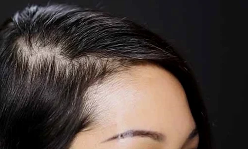 1 tratamente pentru parul rar j7gu jpg jpeg