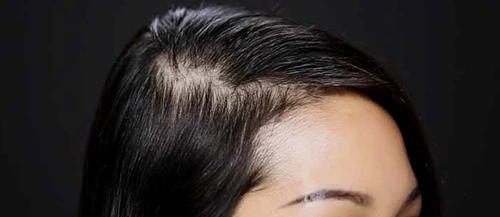 1 tratamente pentru parul rar j7gu jpg jpeg