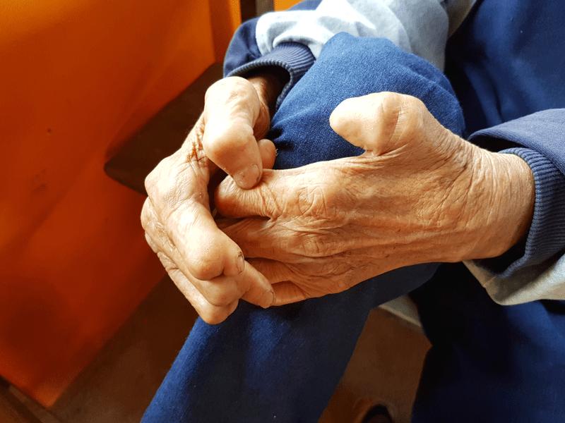 Studiu: Lepra este capabilă să regenereze organele