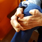 Mâinile unei femei afectate de lepră FOTO Shutterstock